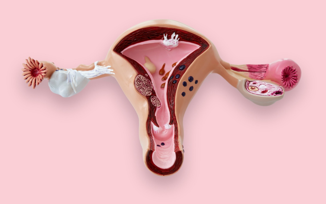 Adenomyose: een vorm van endometriose