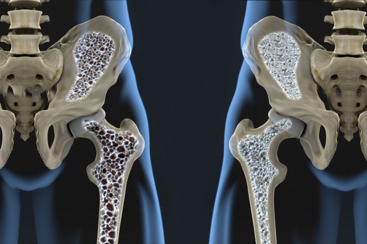 osteoporose<br />
