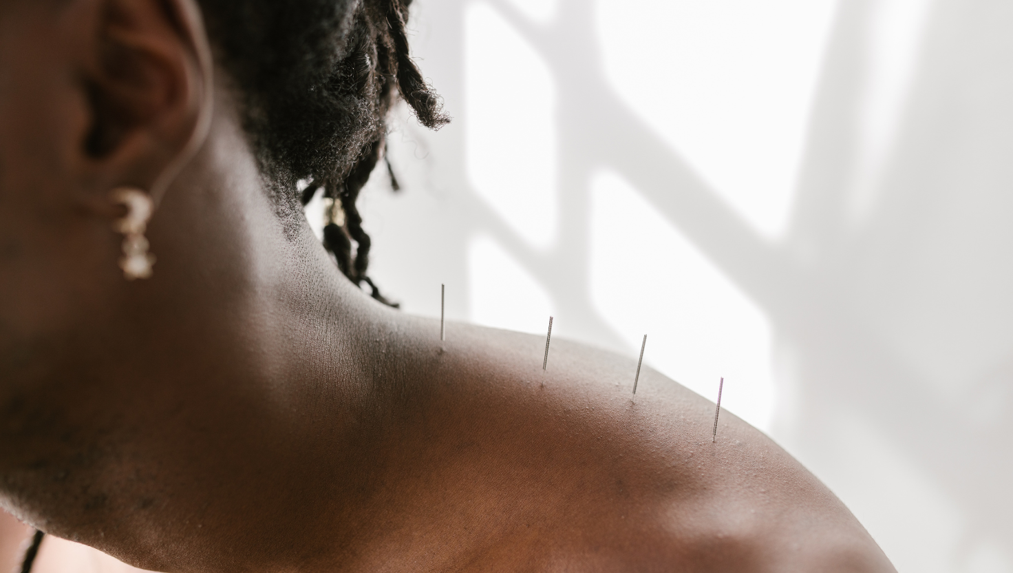 Acupunctuur bij Balance.Gent